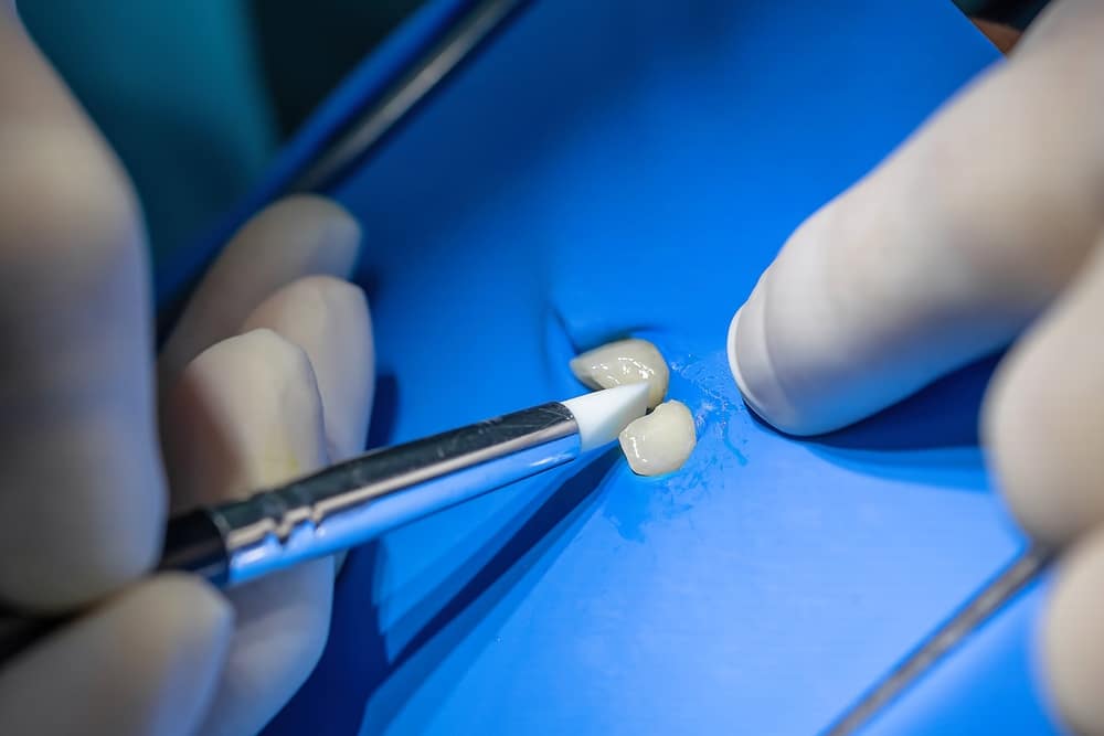 Root Canal Therapy Palmdale