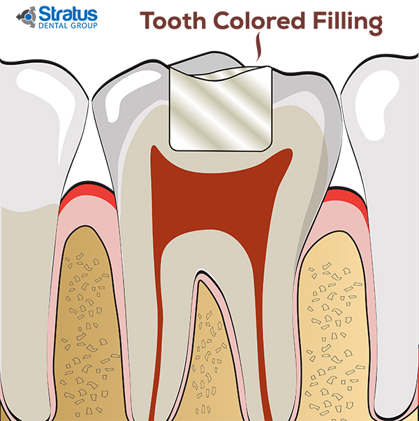 Tooth Colored Feeling